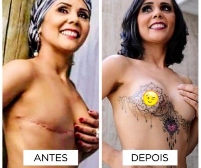 Reconstrucao de Areola-fernanda-mello_antes-depois-01