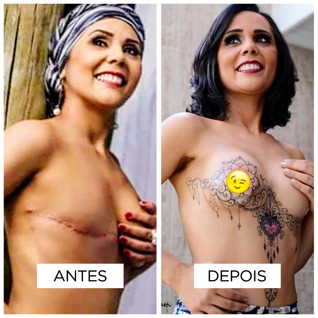 Reconstrucao de Areola-fernanda-mello_antes-depois-01