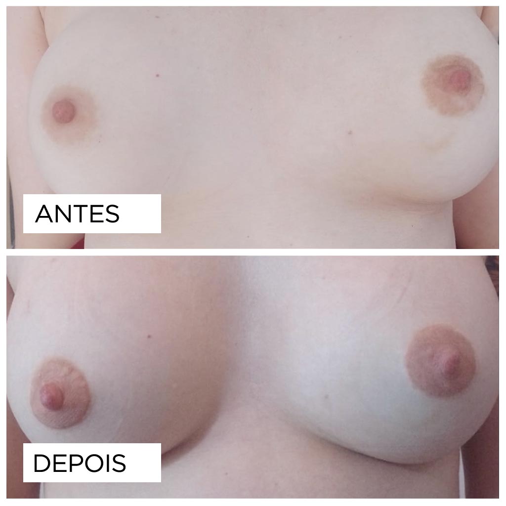 Reconstrucao de Areola-fernanda-mello_antes-depois-02