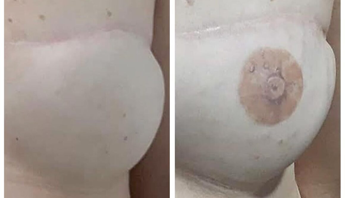 Reconstrucao de Areola-fernanda-mello_antes-depois-03