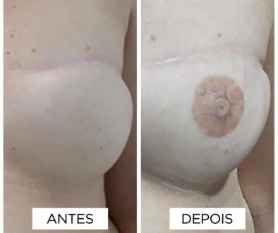 Reconstrucao de Areola-fernanda-mello_antes-depois-03