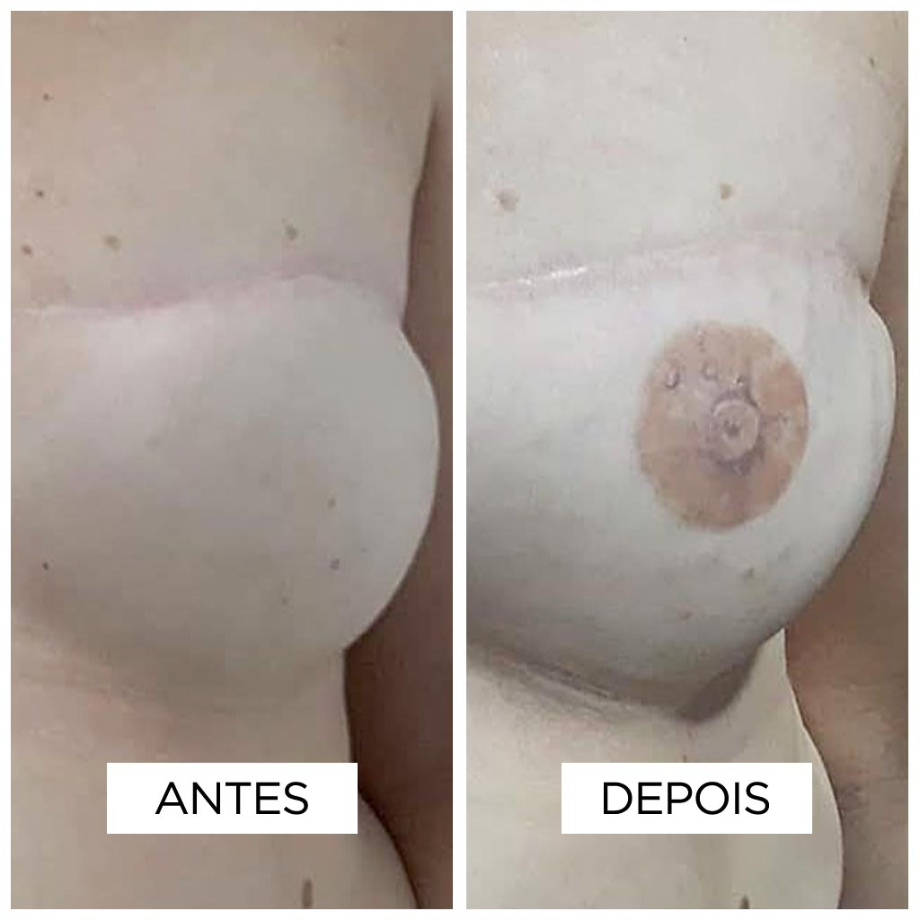 Reconstrucao de Areola-fernanda-mello_antes-depois-03