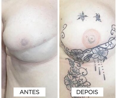 Reconstrucao de Areola-fernanda-mello_antes-depois-04