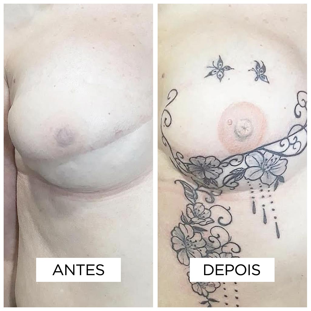 Reconstrucao de Areola-fernanda-mello_antes-depois-04